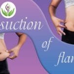 Liposuction of flanks