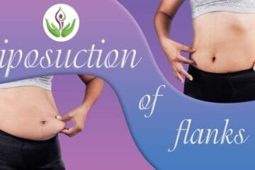 Liposuction of flanks