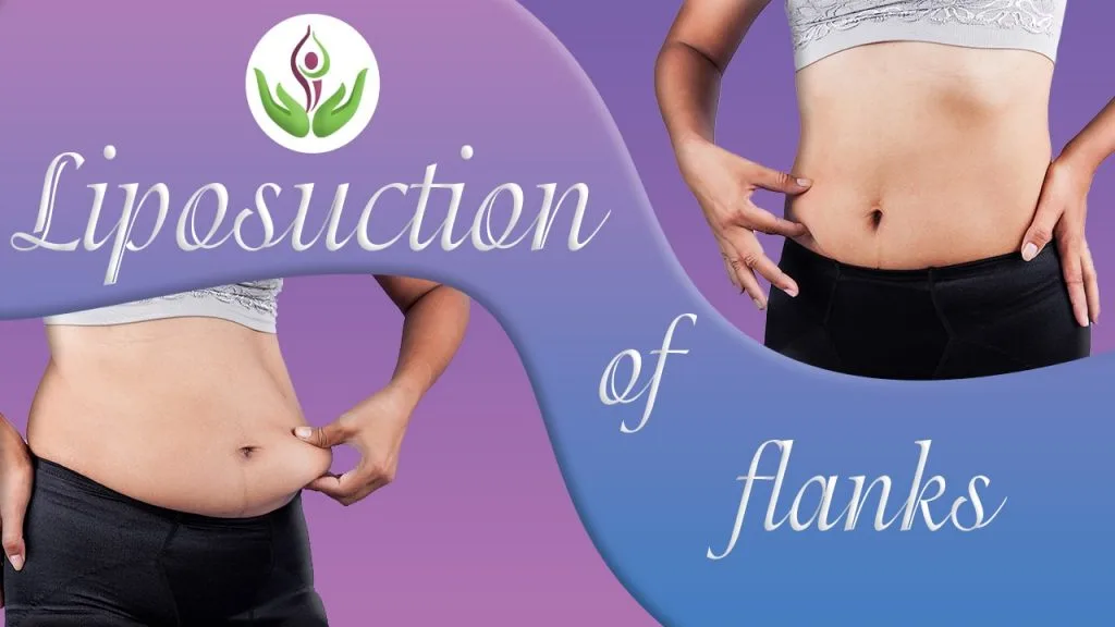 Liposuction of flanks