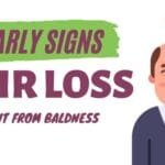 10 Early Signs Of Hair Loss That Can Help You Prevent Baldness!