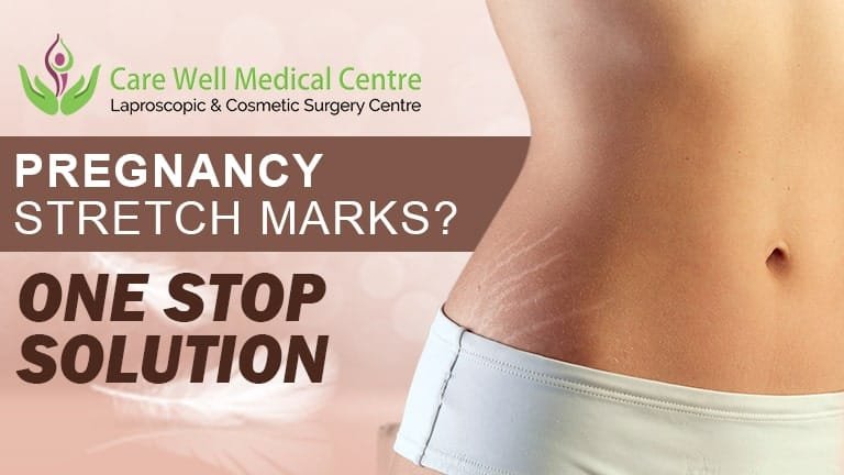 Get Rid of Pregnancy Stretch Marks? We’ll Provide One Stop Solution