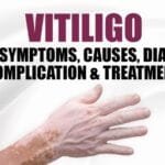 Vitiligo: Types, Symptoms, Causes, Diagnose, Complication & Treatment