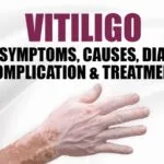 Vitiligo: Types, Symptoms, Causes, Diagnose, Complication & Treatment