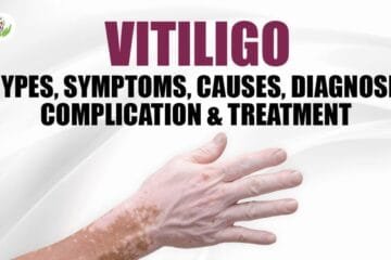 Vitiligo: Types, Symptoms, Causes, Diagnose, Complication & Treatment