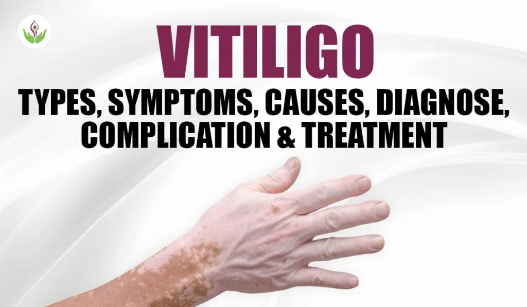 Vitiligo: Types, Symptoms, Causes, Diagnose, Complication & Treatment