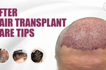 After Hair transplant Care Tips – Guaranteed Get Best Results