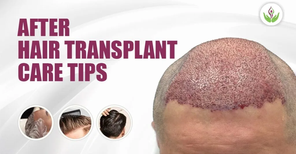 After Hair transplant Care Tips – Guaranteed Get Best Results