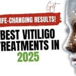 Best Vitiligo Treatments