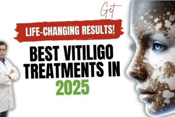 Best Vitiligo Treatments