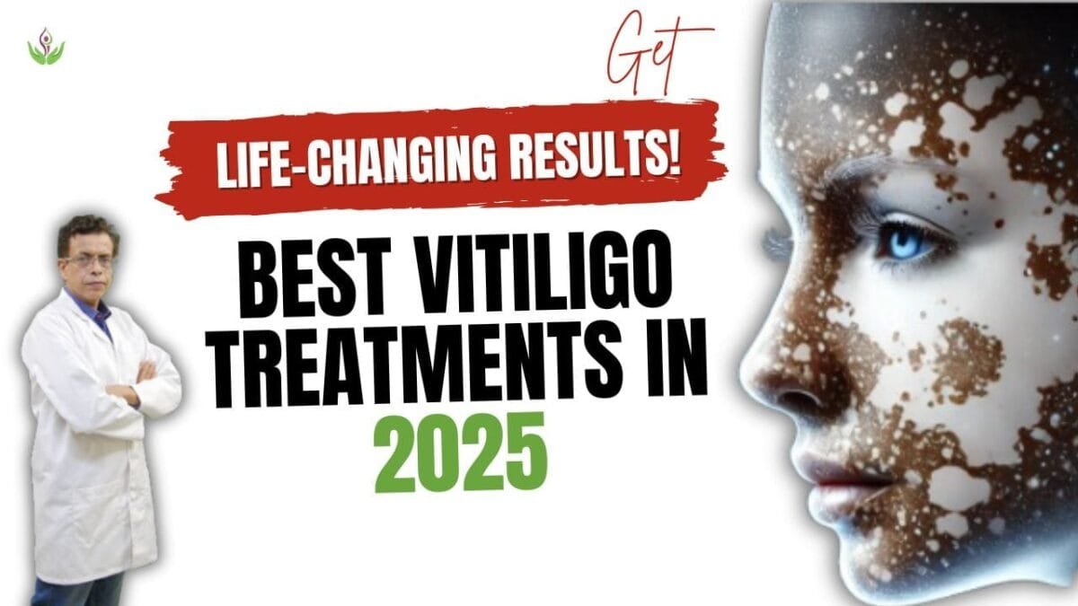 Best Vitiligo Treatments