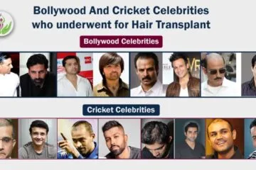 Bollywood And Cricket Celebrities who underwent Hair Transplant, Bollywood actors hair loss, Akshay Kumar's hair transplant, Vivek Oberoi's hair loss, Akshaye Khanna's hair transplant,Virendra Sehwag's hair transplant, hair transplant of Indian celebrities
