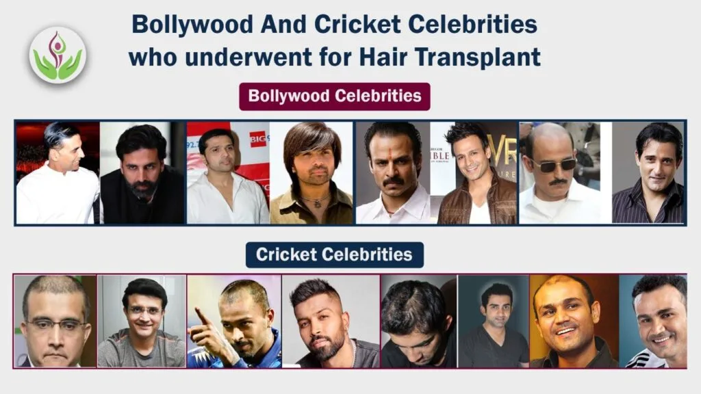 Bollywood And Cricket Celebrities who underwent Hair Transplant, Bollywood actors hair loss, Akshay Kumar's hair transplant, Vivek Oberoi's hair loss, Akshaye Khanna's hair transplant,Virendra Sehwag's hair transplant, hair transplant of Indian celebrities