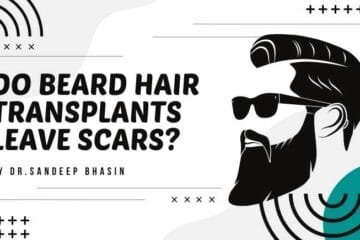 Do Beard Hair Transplants Leave Scars?