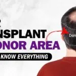 Hair Transplant and Donor Area: Need to Know Everything