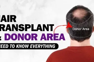 Hair Transplant and Donor Area: Need to Know Everything