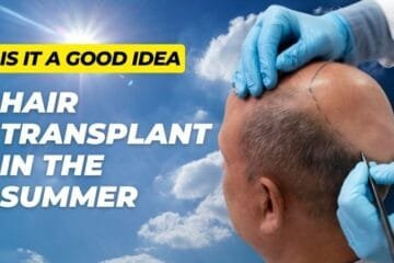 Hair Transplant in the Summer? Is it a Good Idea?