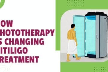 How Phototherapy Is Changing Vitiligo Treatment?