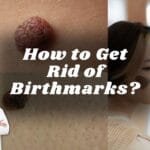 How to Get Rid of Birthmarks?