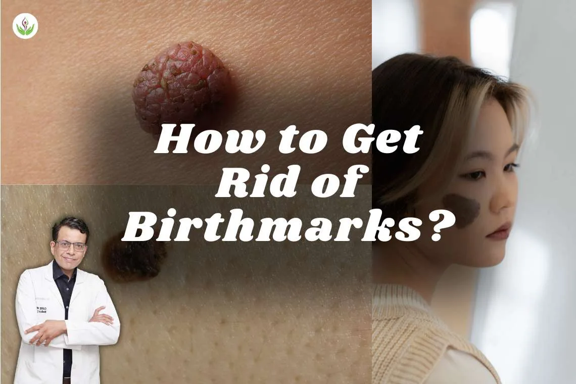 How to Get Rid of Birthmarks?