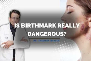 Is a birthmark really dangerous?