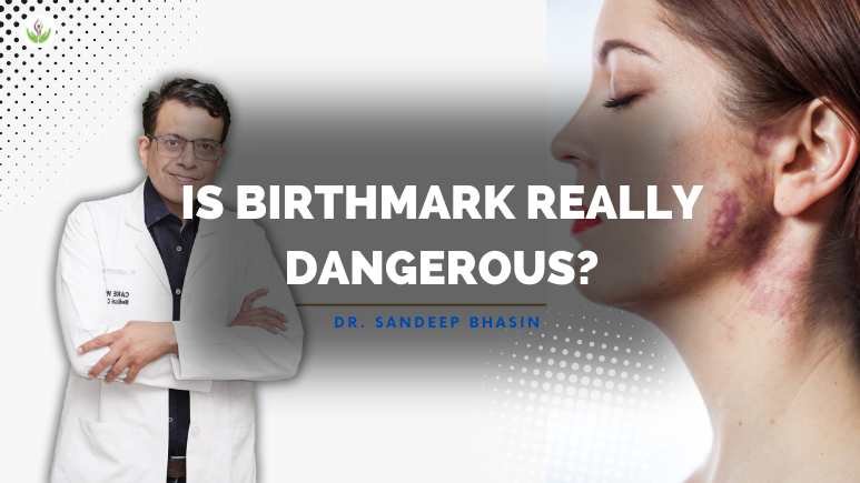 Is a birthmark really dangerous?