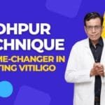 Jodhpur Technique A Best Game-Changer in Treating Vitiligo