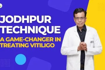 Jodhpur Technique A Best Game-Changer in Treating Vitiligo