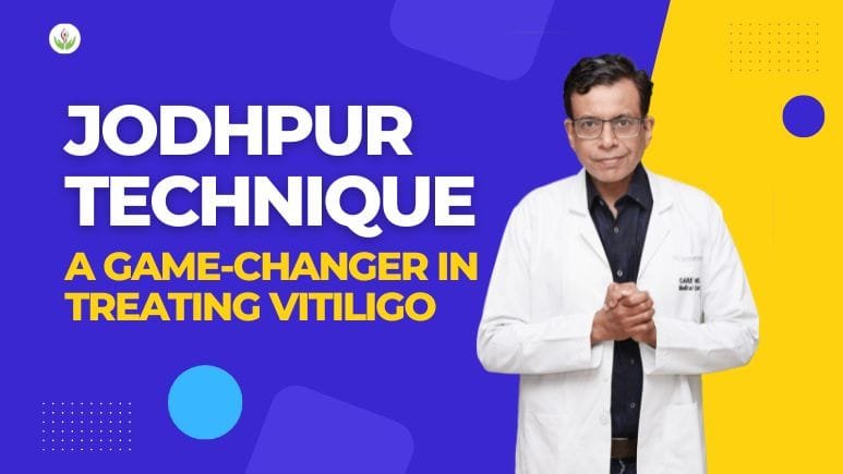 Jodhpur Technique A Best Game-Changer in Treating Vitiligo