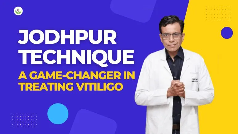 Jodhpur Technique A Best Game-Changer in Treating Vitiligo