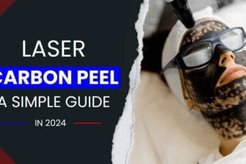 Laser Carbon Peel: A Simple Guide