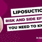 Liposuction: Risk and Side Effects That You Need To Know