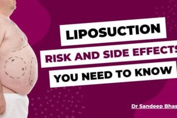 Liposuction: Risk and Side Effects That You Need To Know