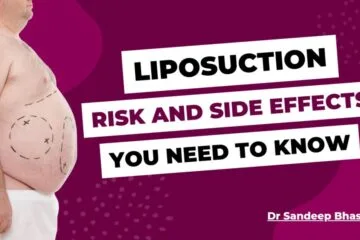 Liposuction: Risk and Side Effects That You Need To Know