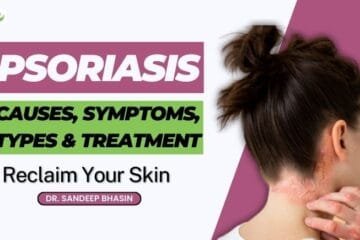 Psoriasis Unveiled: Causes, Types, Symptoms and Solutions