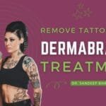 Dermabrasion Treatment for Tattoo Removal