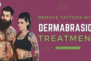 Dermabrasion Treatment for Tattoo Removal