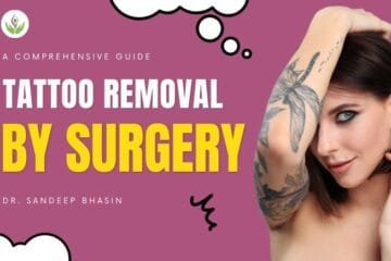 Tattoo Removal by Surgery: A Comprehensive Guide