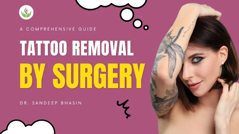 Tattoo Removal by Surgery: A Comprehensive Guide