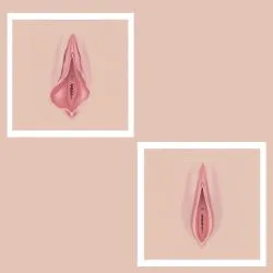 Vaginoplasty Surgery in Delhi