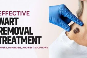 Effective Wart Removal Treatments: Causes, Diagnosis