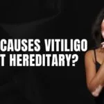 What Causes Vitiligo, and Is It Hereditary?