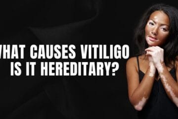 What Causes Vitiligo, and Is It Hereditary?