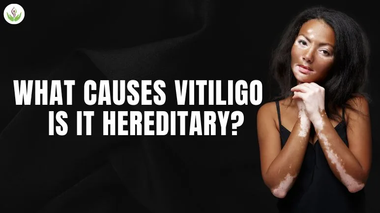 What Causes Vitiligo, and Is It Hereditary?