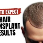 How Soon Can You See Hair Transplant Results