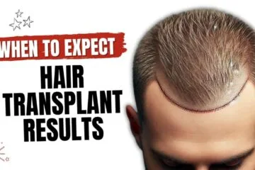 How Soon Can You See Hair Transplant Results