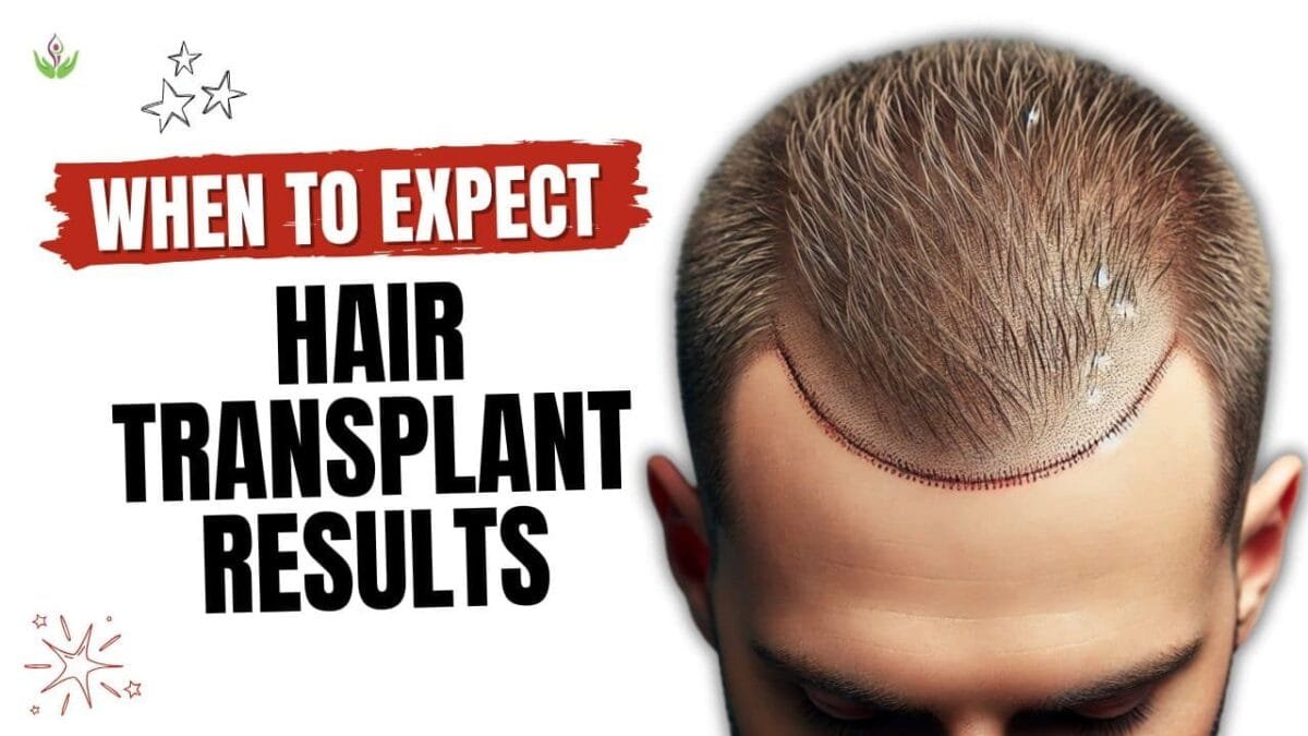 How Soon Can You See Hair Transplant Results
