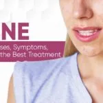 ACNE – Causes, Symptoms, Risks & Treatment