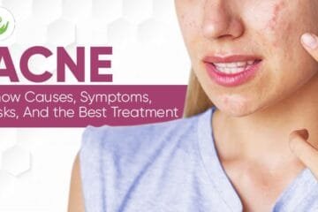 ACNE – Causes, Symptoms, Risks & Treatment