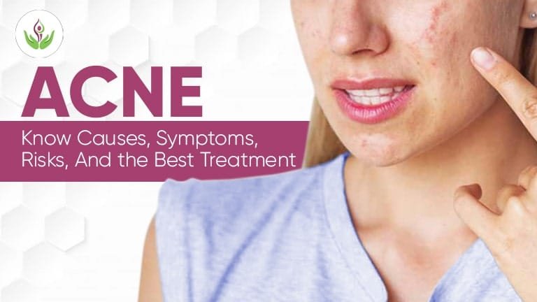 ACNE – Causes, Symptoms, Risks & Treatment