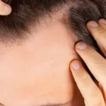 Alopecia Treatment for Baldness